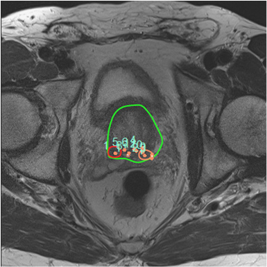 MRT-Bild, Copyright: Klinik für Urologie/MHH