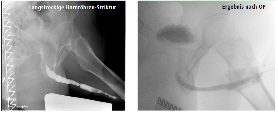 Röntgenbilder: Mit Striktur und nach OP, Copyright: Klinik für Urologie/MHH