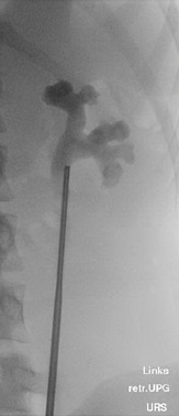 Röntgenbild einer semirigiden (starren) Ureterorenoskopie, Copyright: Klinik für Urologie/MHH