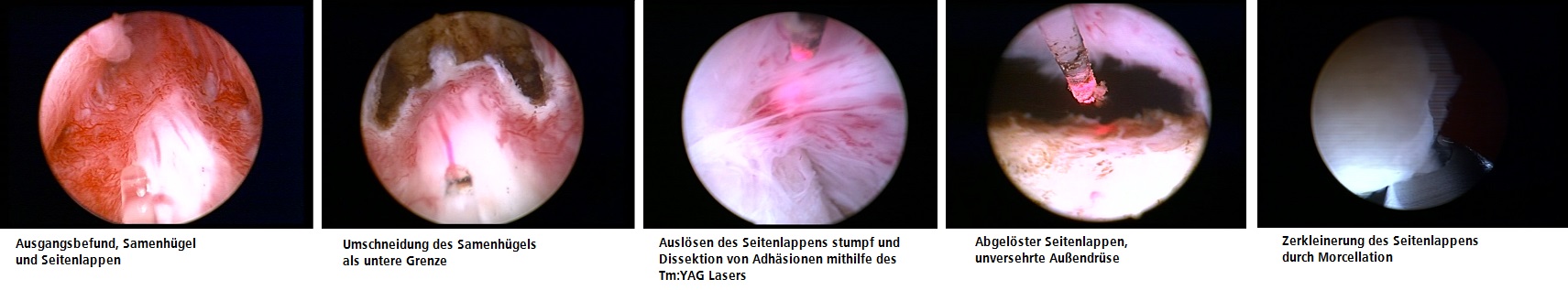 Verlauf einer ThuLEP, Copyright: Klinik für Urologie/MHH