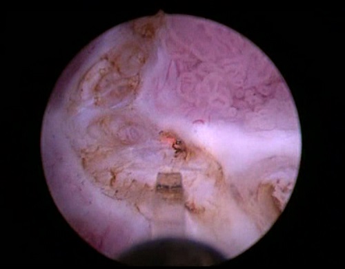 Abtragung eines Harnblasentumors mit Laser (Thulium YAG), Copyright: Klinik für Urologie/MHH