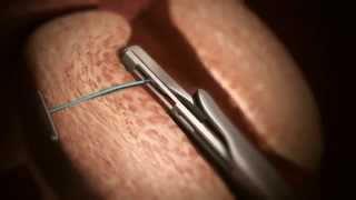 Urolift® - Das Prostata-Lifting Urolift® - Das Prostata-Lifting