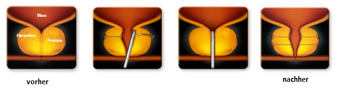 Urolift® - Das Prostata-Lifting Urolift® - Das Prostata-Lifting, Skizze, Copyright: Urolift