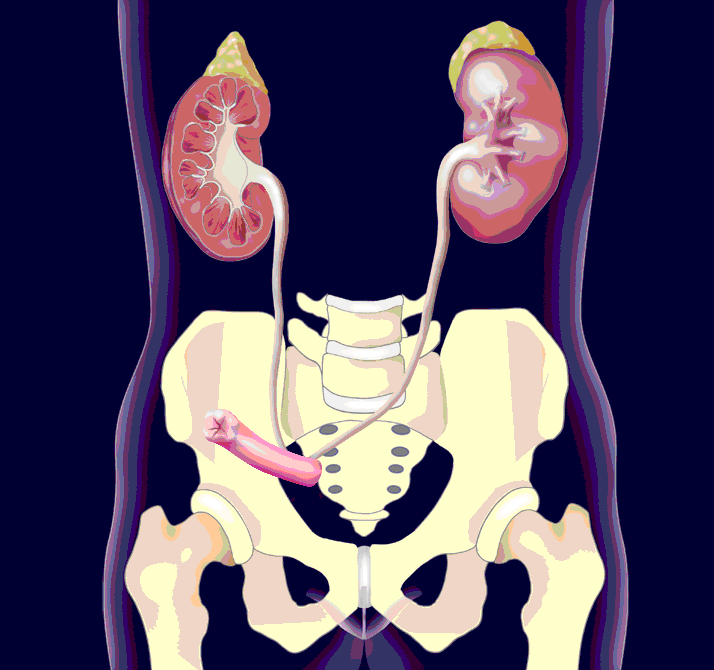 Harnableitung mittels Ileum Conduit, Copyright: Klinik für Urologie/MHH