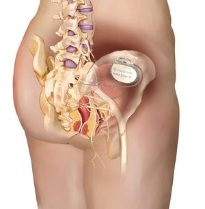 Implantation eines Schrittmachersystems, Copyright: www.medtronic.com