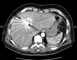 RFA einer Lebermetastase bei Nierenzellkarzinom. Die Position der RFA-Sonde erfolgt in der Computertomographie. Copyright: Klinik für Urologie/MHH