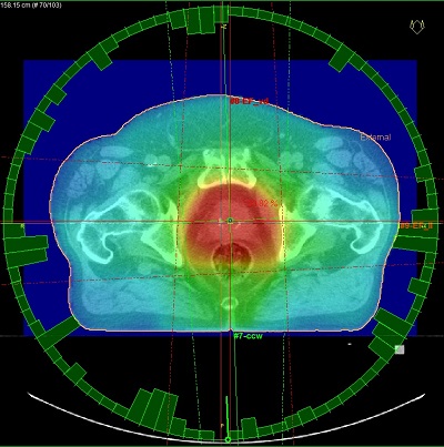 Computerbild einer Dosisverteilung, Copyright: Klinik für Urologie/MHH