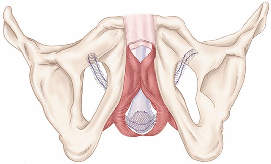 AdVanceXP® Die transobturatorische nicht adjustierbare Schlinge: AdVanceXP®, Copyright: Firma Boston Scientific
