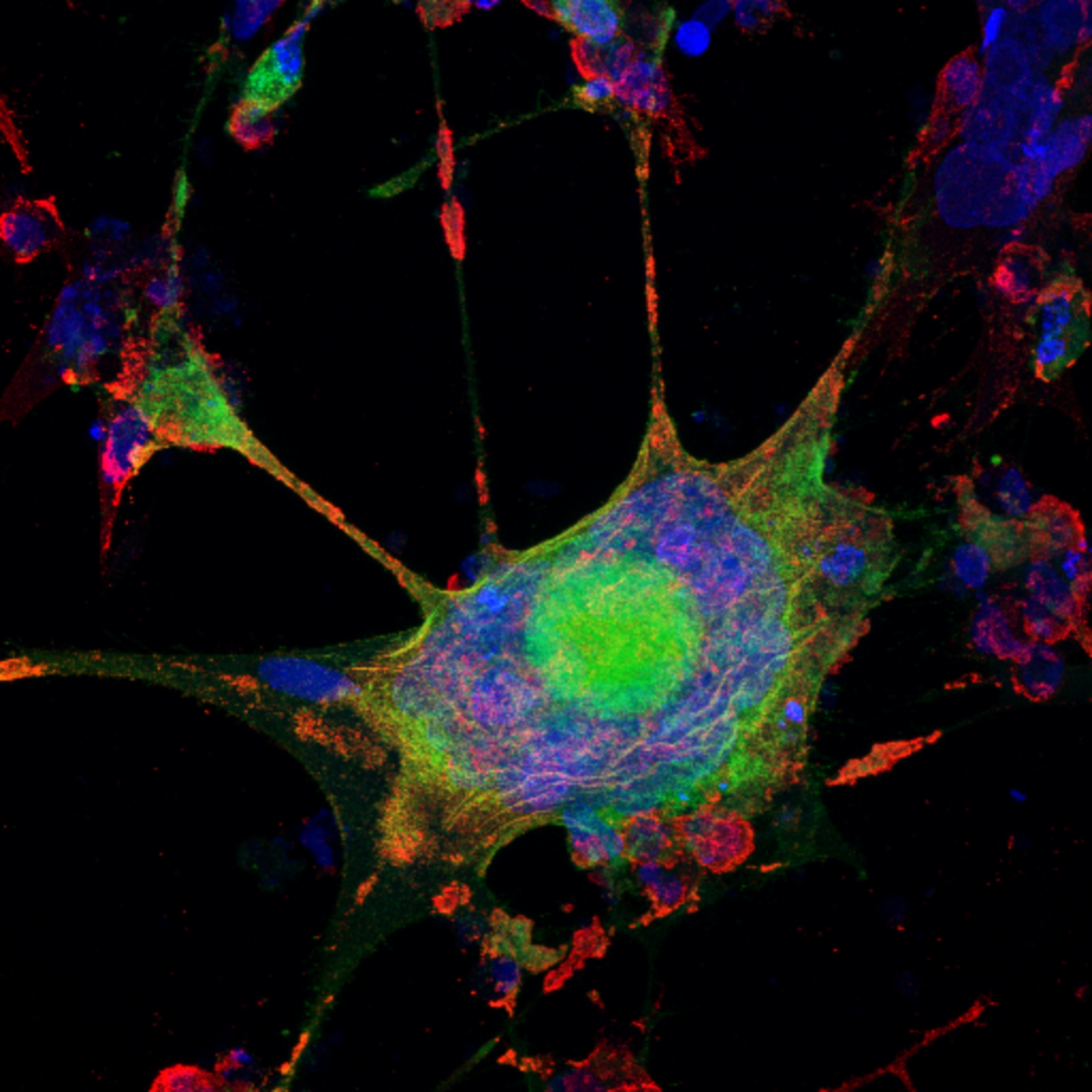 Syncytium of VZV infected cells